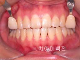 치아미백